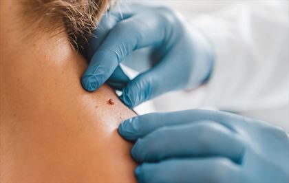 usuwanie zmian skórnych